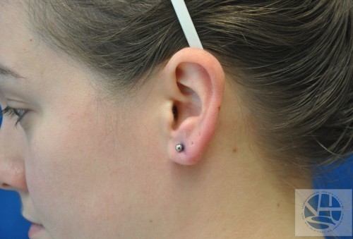 Gauged Earlobes Before and After | Little Lipo