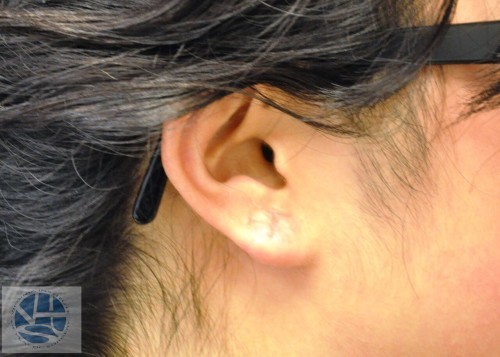 Gauged Earlobes Before and After | Little Lipo