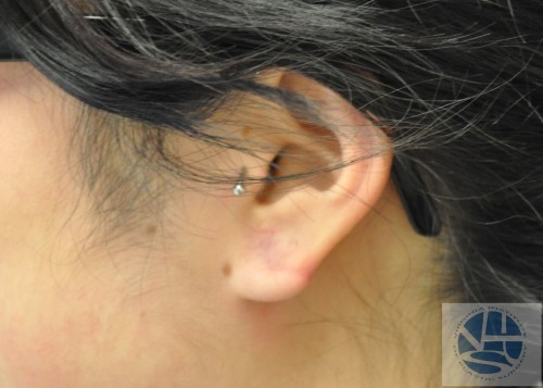 Gauged Earlobes Before and After | Little Lipo