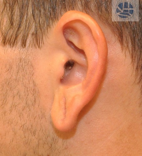 Gauged Earlobes Before and After | Little Lipo