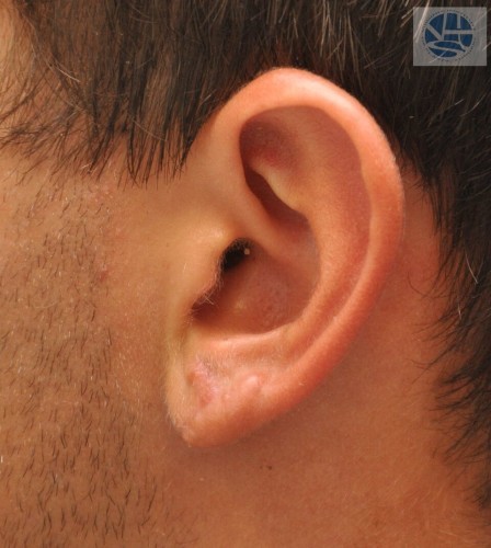 Gauged Earlobes Before and After | Little Lipo