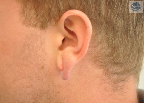 Gauged Earlobes Before and After | Little Lipo