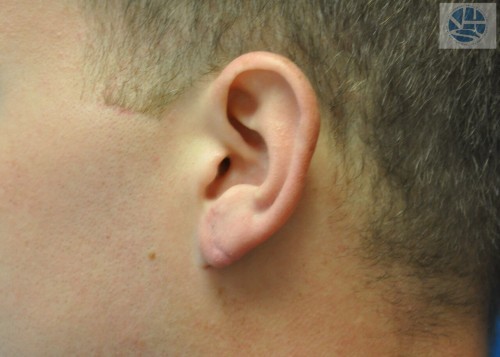 Gauged Earlobes Before and After | Little Lipo