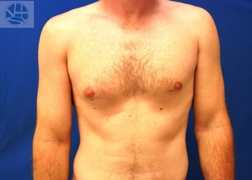 Gynecomastia Before and After | Little Lipo