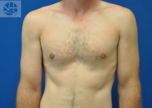 Gynecomastia Before and After | Little Lipo