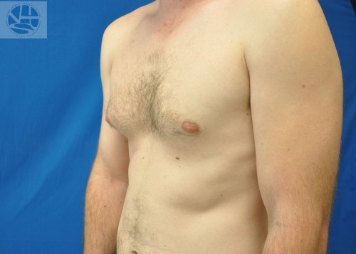 Gynecomastia Before and After | Little Lipo