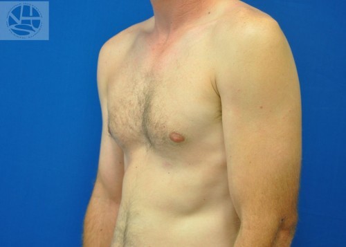 Gynecomastia Before and After | Little Lipo