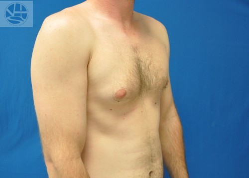 Gynecomastia Before and After | Little Lipo