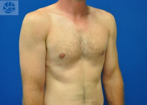 Gynecomastia Before and After | Little Lipo