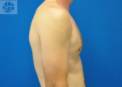 Gynecomastia Before and After | Little Lipo