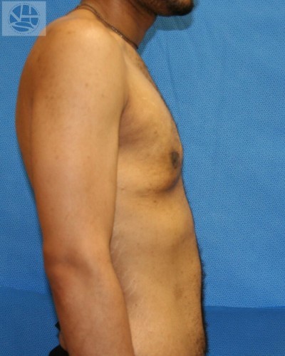 Gynecomastia Before and After | Little Lipo