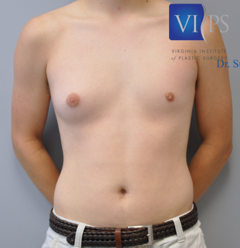 Gynecomastia Before and After | Little Lipo