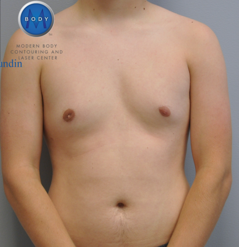 Gynecomastia Before and After | Little Lipo