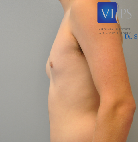 Gynecomastia Before and After | Little Lipo