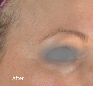 Infini Before and After | Little Lipo