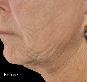 Infini Before and After | Little Lipo