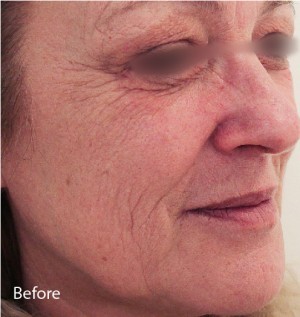 Infini Before and After | Little Lipo