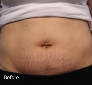 Infini Before and After | Little Lipo