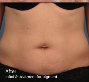 Infini Before and After | Little Lipo