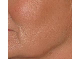 Infini Before and After | Little Lipo
