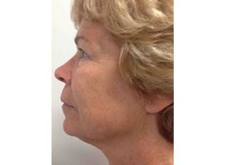 Infini Before and After | Little Lipo