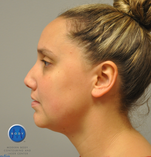 J Plasma Necklift Before and After | Little Lipo