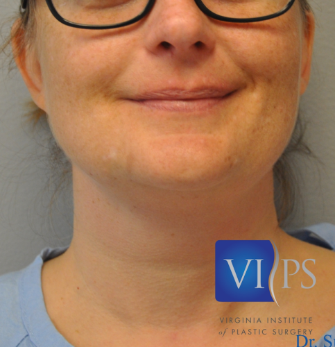 Neck Liposuction