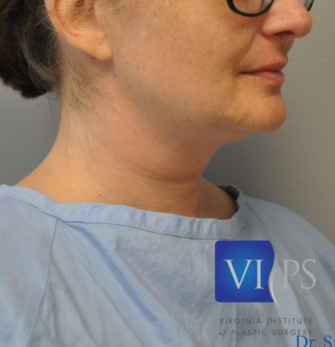 J Plasma Necklift Before and After | Little Lipo