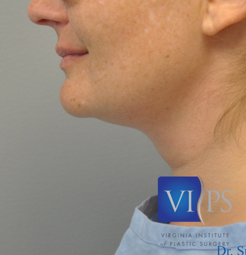 J Plasma Necklift Before and After | Little Lipo