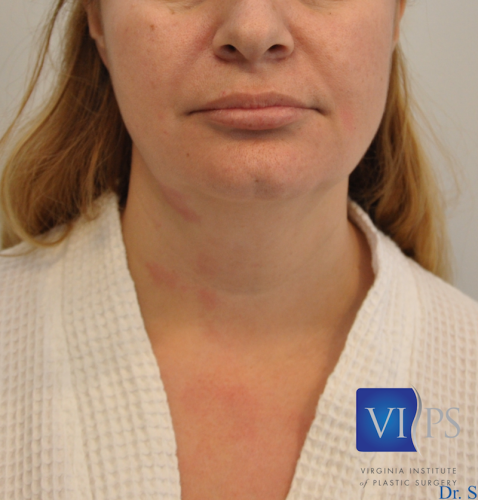 Neck Liposuction Richmond