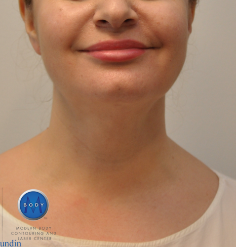 Neck Liposuction
