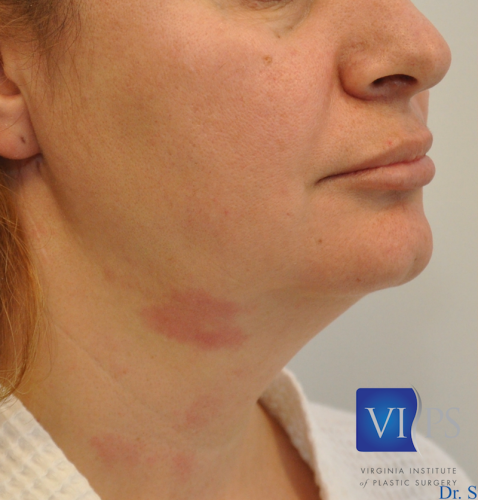 J Plasma Necklift Before and After | Little Lipo