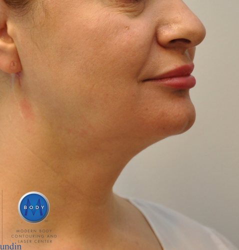 J Plasma Necklift Before and After | Little Lipo