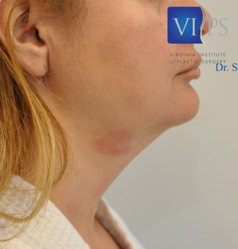 J Plasma Necklift Before and After | Little Lipo