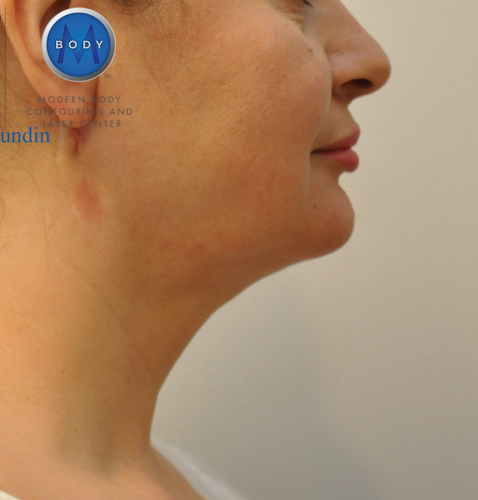 J Plasma Necklift Before and After | Little Lipo