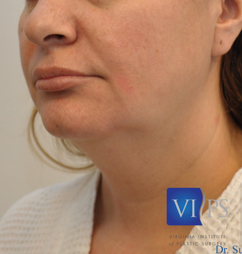 J Plasma Necklift Before and After | Little Lipo