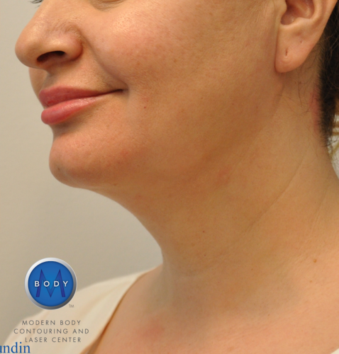 J Plasma Necklift Before and After | Little Lipo