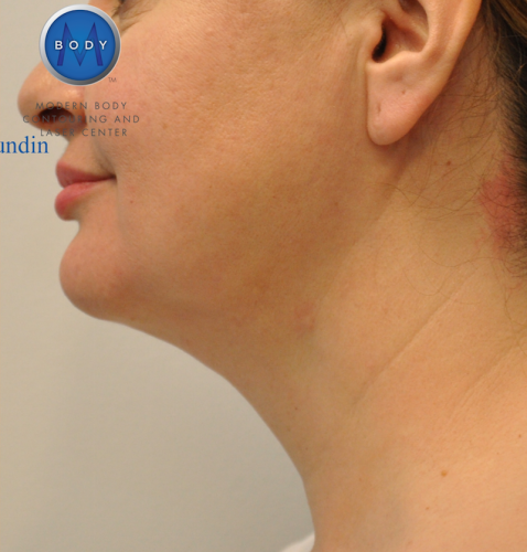 J Plasma Necklift Before and After | Little Lipo