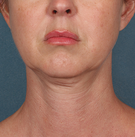 Kybella Before and After | Little Lipo