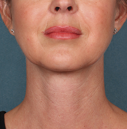 Kybella Before and After | Little Lipo