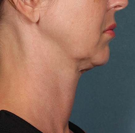 Kybella Before and After | Little Lipo