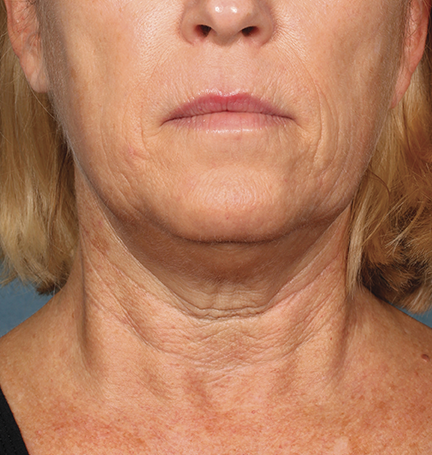 Kybella Before and After | Little Lipo