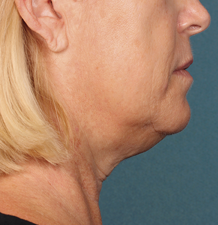 Kybella Before and After | Little Lipo