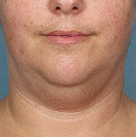 Kybella Before and After | Little Lipo