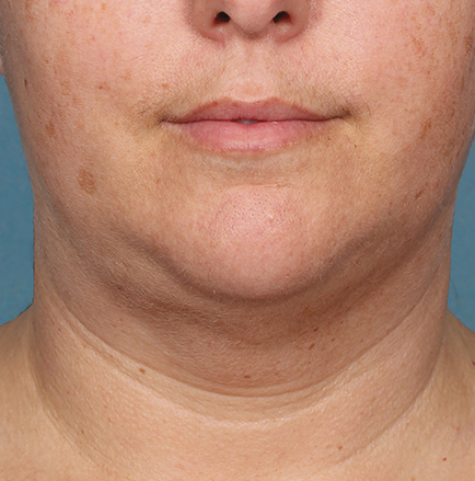 Kybella Before and After | Little Lipo