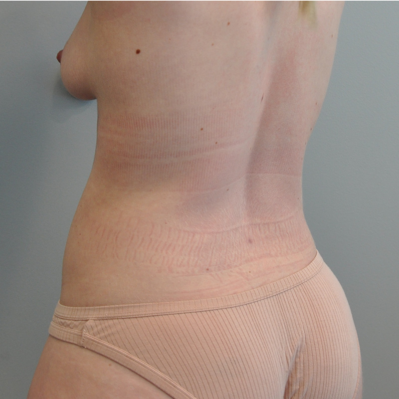 Liposuction Before and After | Little Lipo