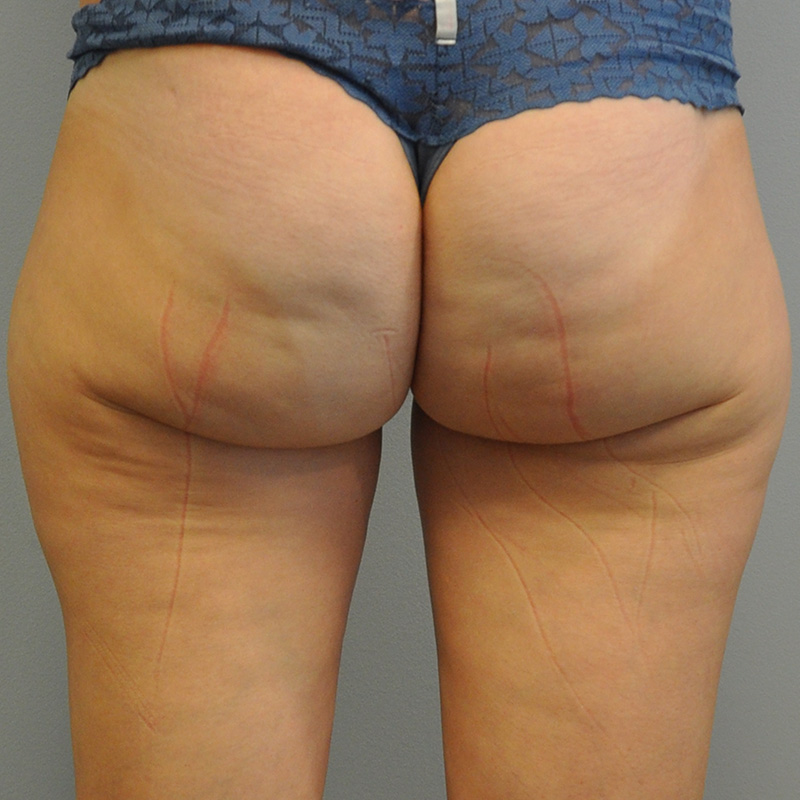 Thigh Liposuction Richmond