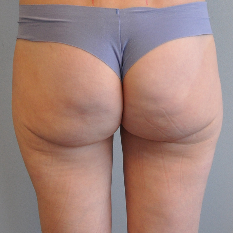 Liposuction Before and After | Little Lipo