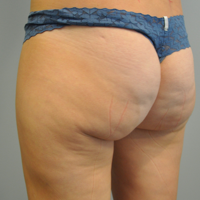 Liposuction Before and After | Little Lipo