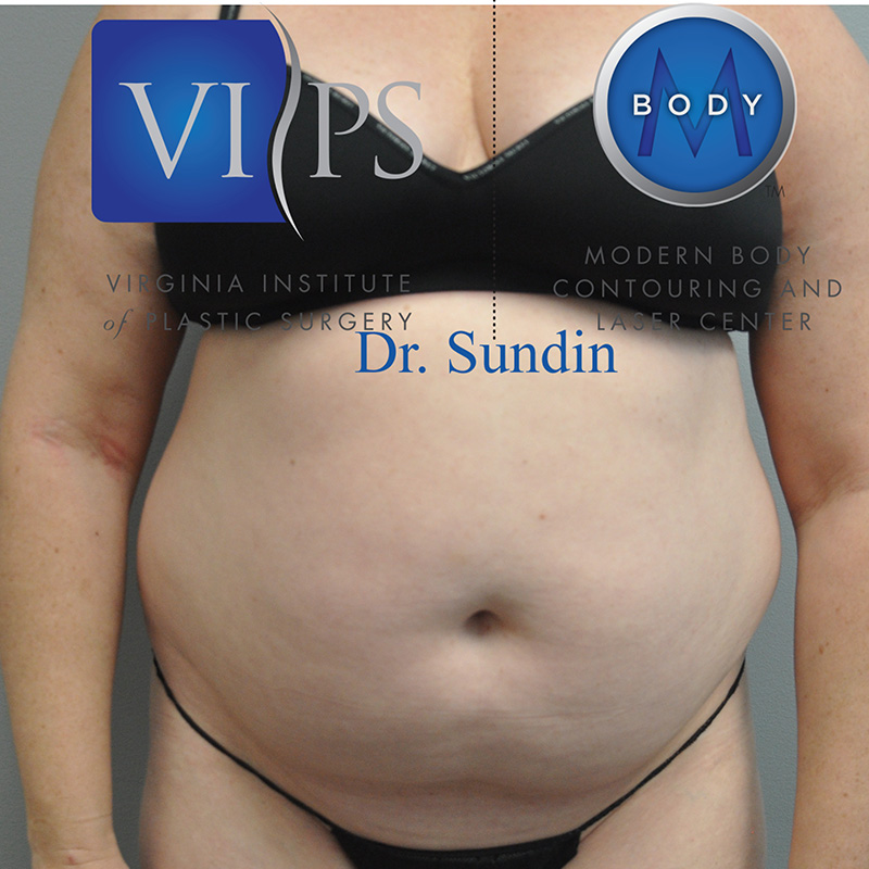 What is Liposuction?